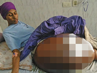 Khối u nặng 55kg mọc trên chân chàng trai có cân nặng 35kg