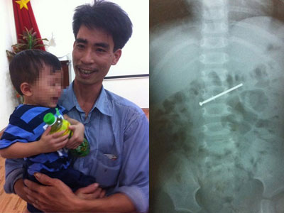 Bé 18 tháng tuổi nuốt đinh vít dài 4,5cm vào bụng