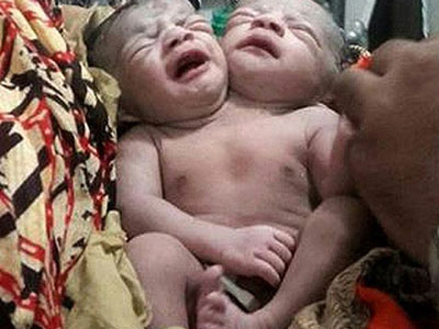 Bé sơ sinh hai đầu chào đời ở Bangladesh