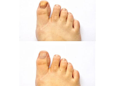 Lạnh chân - dấu hiệu bệnh tim mạch