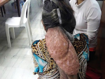 Cụ bà mang khối u hình thù quái dị ở sau gáy