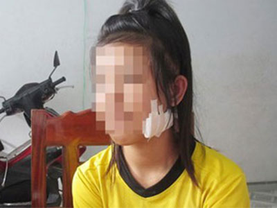 Ngăn bạn đánh nhau, nữ sinh lớp 9 bị chặn đường rạch mặt