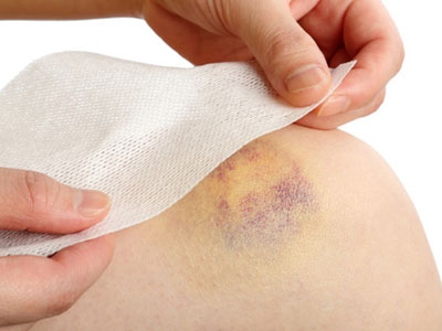 Vết bầm tím da đột nhiên xuất hiện cảnh báo nhiều bệnh