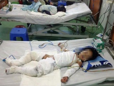 Ngã vào nồi nước sôi, bé gái 2 tuổi bị bỏng toàn thân
