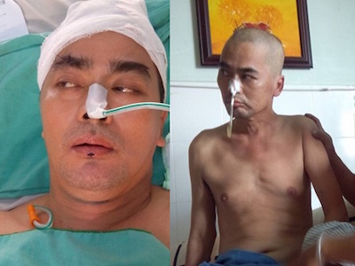Nguyễn Hoàng cử động được tay phải sau hơn một tháng mổ não