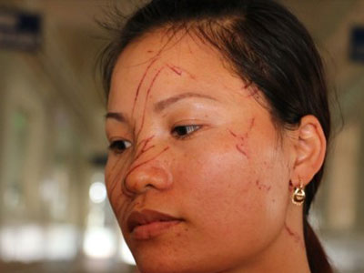 Hai mẹ con bị hàng xóm rạch mặt dã man