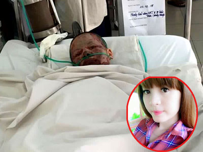 Xót thương cô gái xinh đẹp bị hủy hoại toàn bộ cơ thể do người yêu tạt xăng đốt