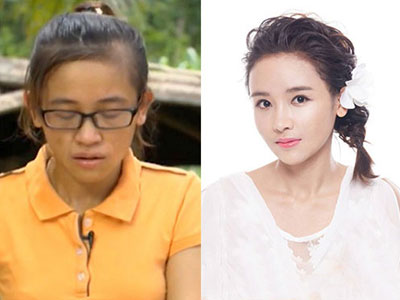 Nữ sinh ĐH Y: "Phẫu thuật thẩm mỹ đã thay đổi cuộc đời tôi"