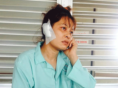 Một phụ nữ bị chồng cắn rớt tai