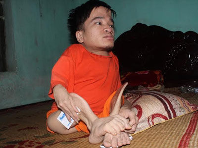 Bị cha hành hạ, người con khuyết tật viết thư máu xin về ở với mẹ