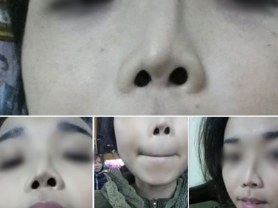 Cô gái Hà Nội bế tắc vì đã 2 lần đau đớn thẩm mỹ nhưng mũi vẫn... lệch