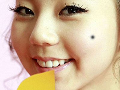 Nốt ruồi chảy máu, coi chừng ung thư