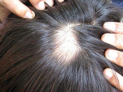 Xài "thần dược" chống hói, lông lá mọc đầy người