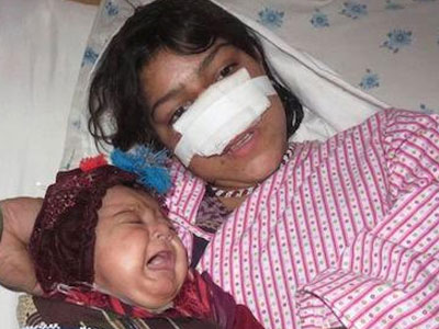 Afghanistan rúng động vì người vợ trẻ bị chồng xẻo mũi
