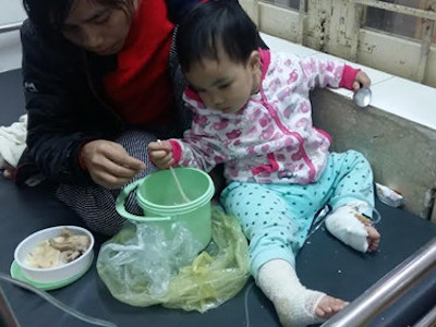 Túi sưởi ấm phát nổ, bé gái bỏng nặng