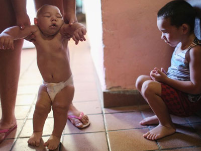 Sự thật gây sốc về virus Zika ăn não người