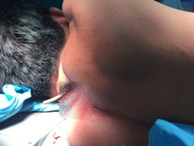 Ngáo đá dùng kéo đâm xuyên phổi nạn nhân