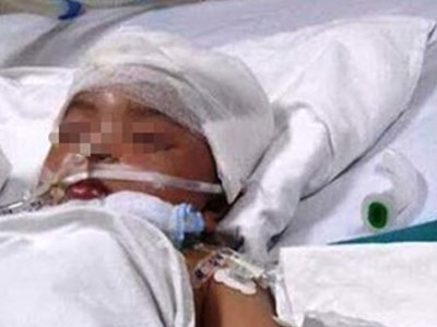 Bé gái 3 tuổi bị vợt cầu lông đâm xuyên não