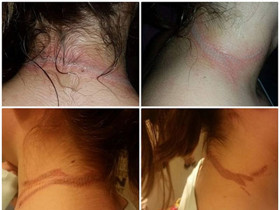 Sự cố bất ngờ từ chiếc điện thoại di động khiến cô bé 13 tuổi mang sẹo suốt đời