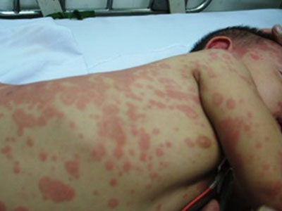 Làm thế nào để phòng tránh viêm não mô cầu?