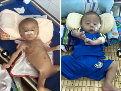 Đằng sau hình ảnh gây sốc về em bé "tim thủng lỗ" trong BV Nhi đồng 1