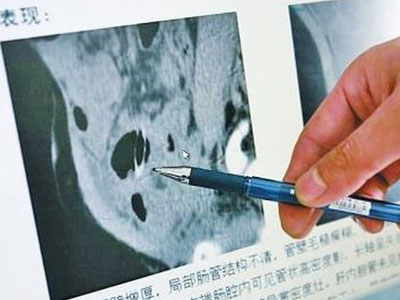 Con trai 8 tháng tuổi bị kim đâm vào gan vì một phút bất cẩn của mẹ