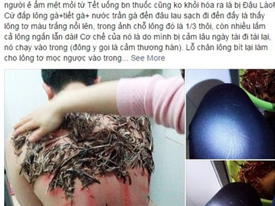 "Đắp lông gà lên lưng để chữa bệnh đậu lào là phản khoa học"