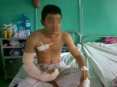Tại sao không thể nối được bàn tay cho thanh niên bị giang hồ chém