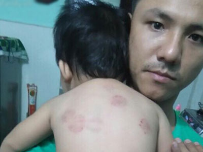 Bé gái 13 tháng tuổi bị bạn cắn chi chít vết thương, chủ trường gọi phụ huynh là "Chí Phèo"