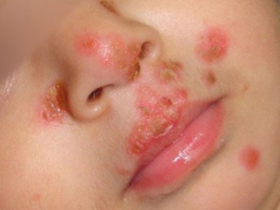 Mụn rộp sinh dục, bệnh lây qua nụ hôn của người lạ