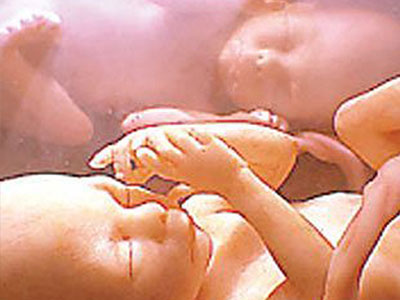 Hai bé sinh đôi "đánh nhau" trong bụng mẹ