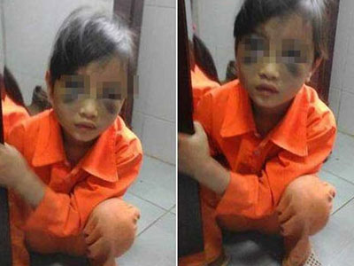 Đánh tím mặt bé gái lớp 1, cô giáo khai gì?