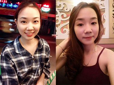 Gương mặt dễ thương của nữ sinh bị tạt axit khiến dân mạng xót xa