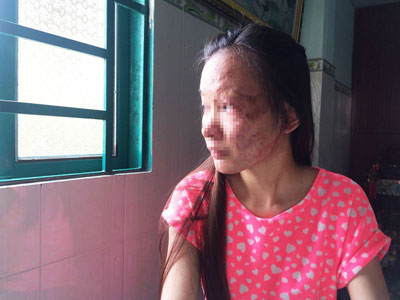Nữ sinh viên bị tạt axit: Nỗi đau ở lại mãi mãi trên khuôn mặt