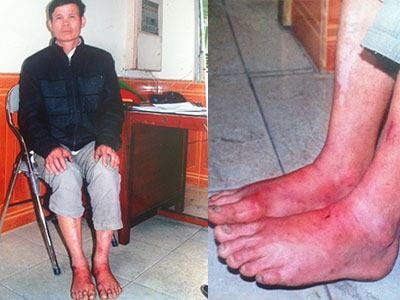Hải Dương: Dân tố công an huyện dùng nhục hình để ép cung?