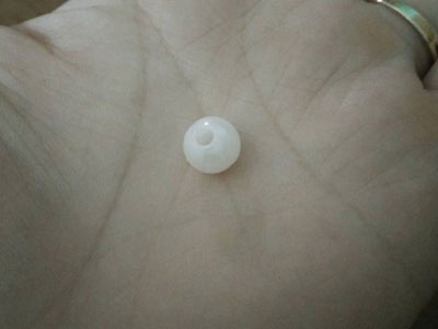 Mẹ hốt hoảng phát hiện hạt cườm trong hốc mũi con sau khi đi mẫu giáo về