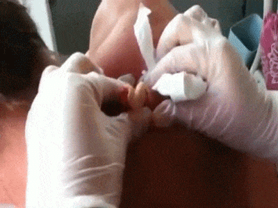 Cảnh nặn mụn khổng lồ đã nằm suốt 30 năm trên lưng