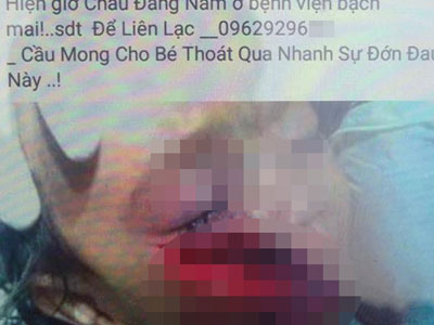 “Ngã ngửa” sự thật thông tin về em bé mồ côi cha mẹ, ngã vào lưỡi cuốc bị thương nghiêm trọng