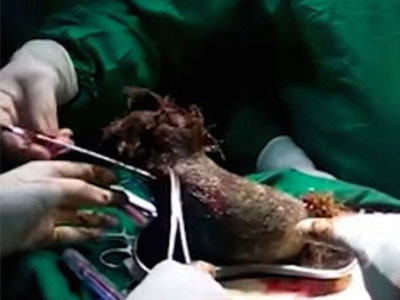 Lấy ra búi tóc nặng gần 1 kg trong bụng bé gái 17 tuổi