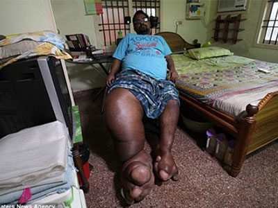 Mắc bệnh lạ, người đàn ông có bàn chân nặng... 100kg
