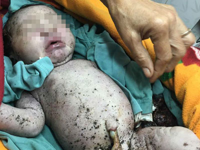 Lâm Đồng: Phát hiện bé trai còn nguyên dây rốn trong hố rác