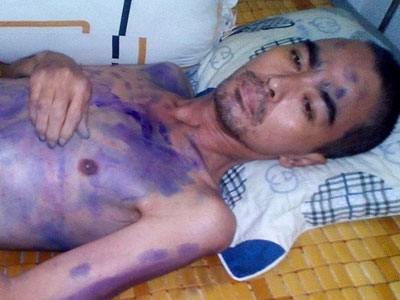 Nguyễn Hoàng sốt li bì vì mắc thủy đậu