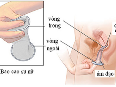 Bao cao su cho phái nữ, bảo bối giúp tránh thai và ngừa bệnh tình dục