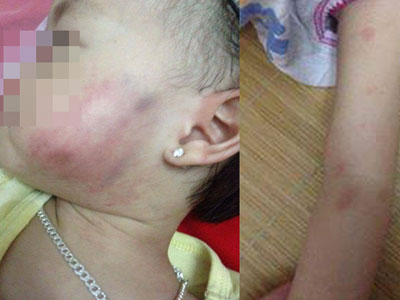 Hà Nội: Bé gái 16 tháng tuổi thâm tím mặt và tay sau khi đi học ở trường mầm non về