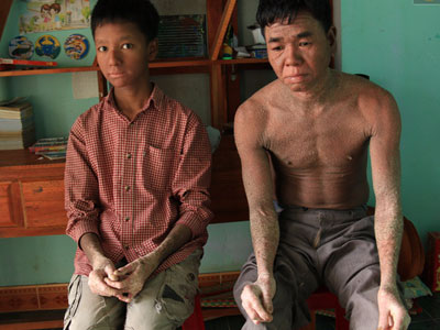 Cậu bé "người rắn" ở Quảng Nam: Hồi trước các bạn bỏ chạy vì sợ, nhưng giờ nhiều bạn thân với con lắm"