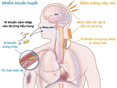 Dấu hiệu cảnh báo bệnh viêm não mô cầu