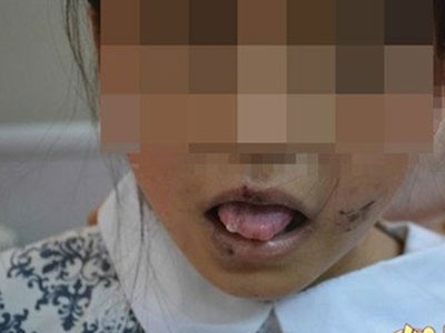 Bé 10 tuổi Trung Quốc bị mẹ nuôi kẹp lưỡi, cắt tai