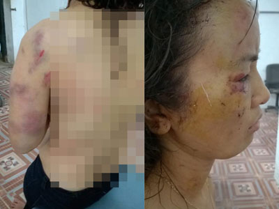 Giáo viên tiểu học bị chồng đánh thâm tím khắp cơ thể?
