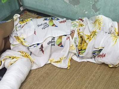 Bé trai 7 tuổi rơi từ độ cao 8m, vỡ sọ não sống sót kỳ diệu