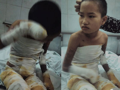 Ngã vào bếp lửa, bé gái bỏng nặng phải cắt 9 ngón tay